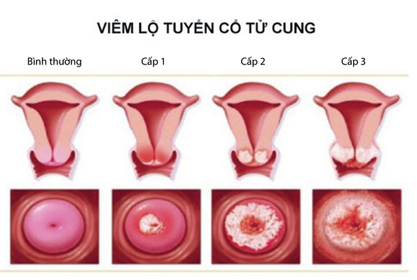 Tổn Thương Lành Tính Cổ Tử Cung
