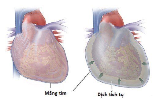 Tràn Dịch Màng Ngoài Tim