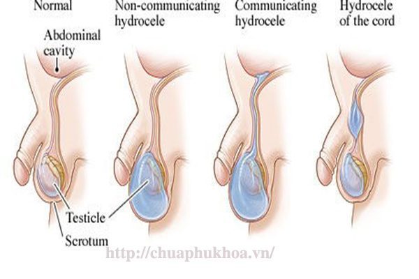 Tràn dịch màng tinh hoàn (Hydrocele)