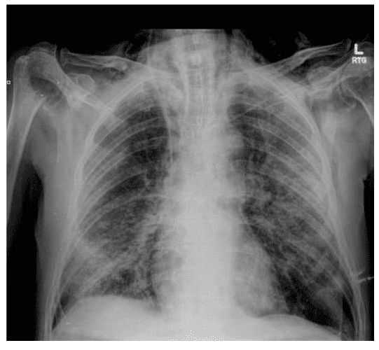 Tràn khí màng phổi tự phát ở bệnh nhân COVID-19 được điều trị bằng ống thông mũi có lưu lượng cao bên ngoài ICU: Loạt ca bệnh