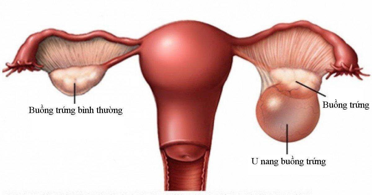U Nang Buồng Trứng