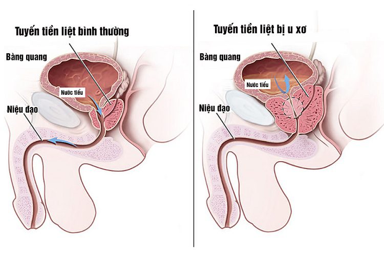 U phì đại lành tính tuyến tiền liệt