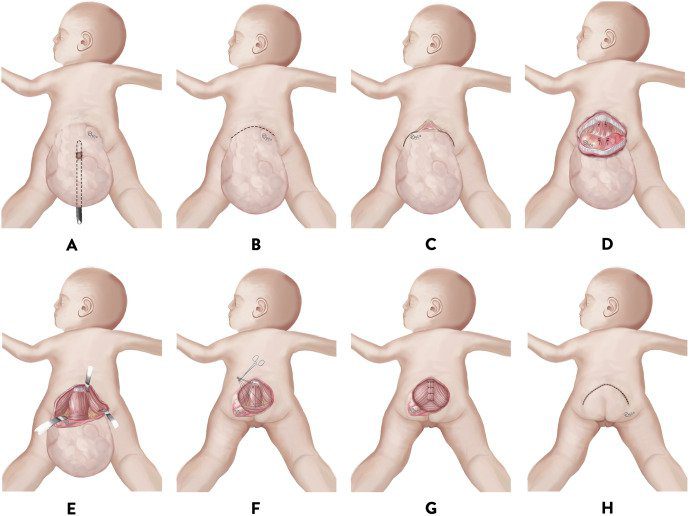 U quái cùng cụt ở trẻ em