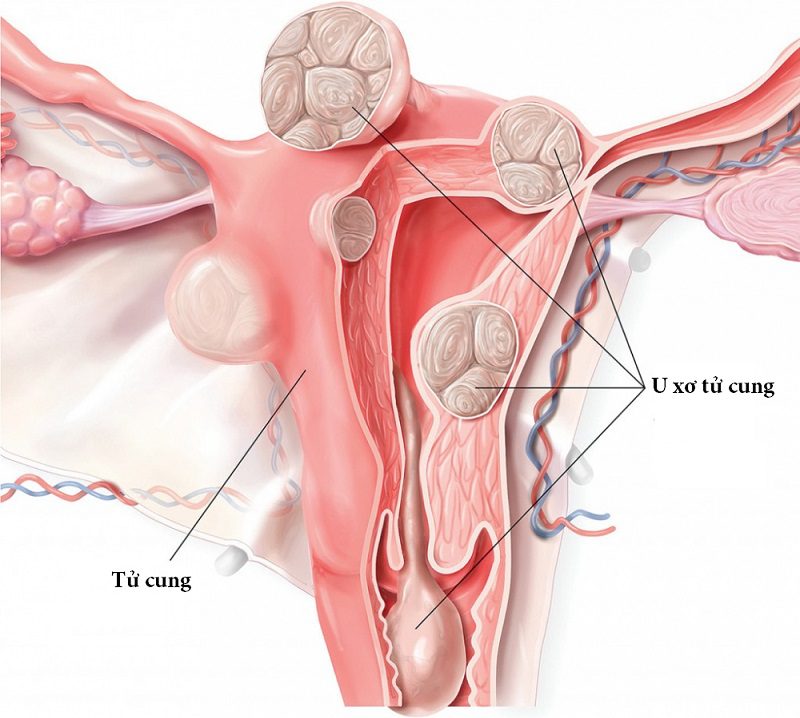 U Xơ Tử Cung (Fibroid)