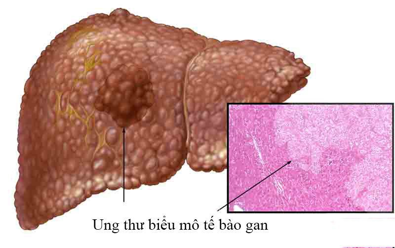 Ung Thư Biểu Mô Tế Bào Gan