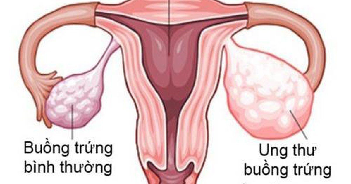 Ung Thư Buồng Trứng