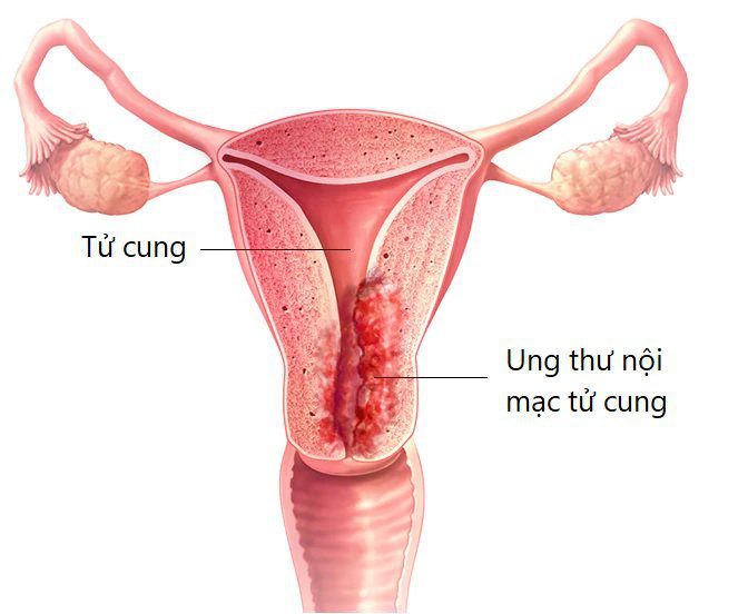 Ung Thư Niêm Mạc Tử Cung