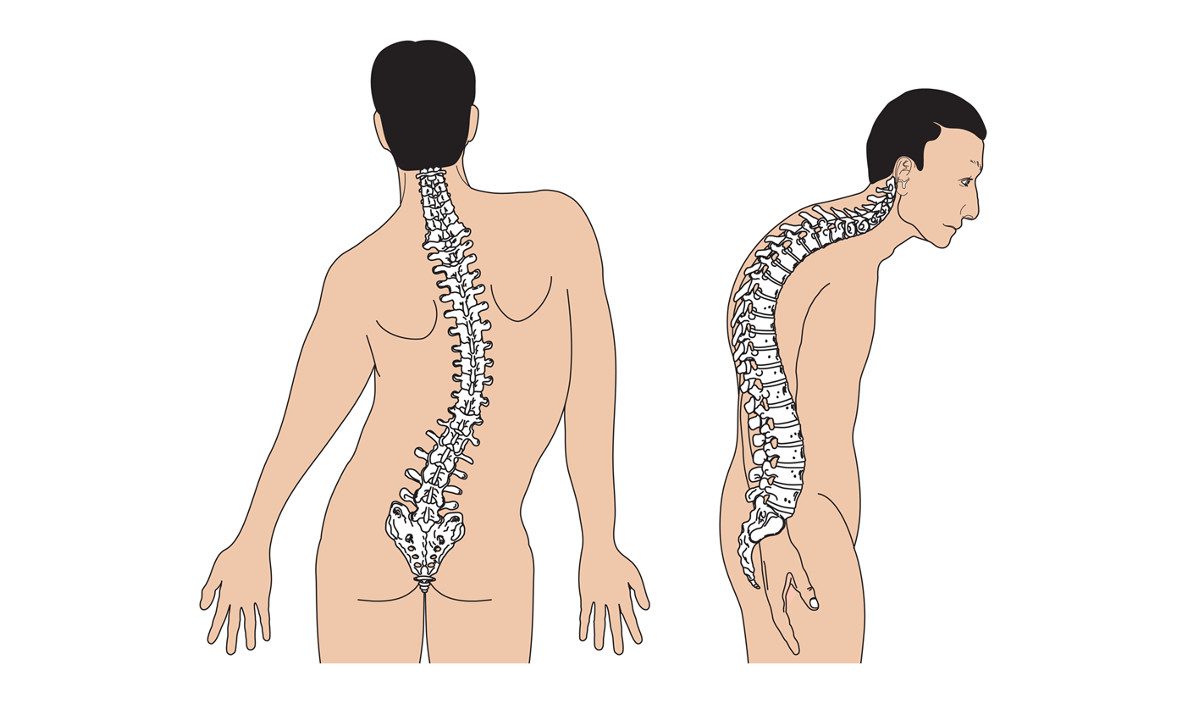 Vẹo cột sống