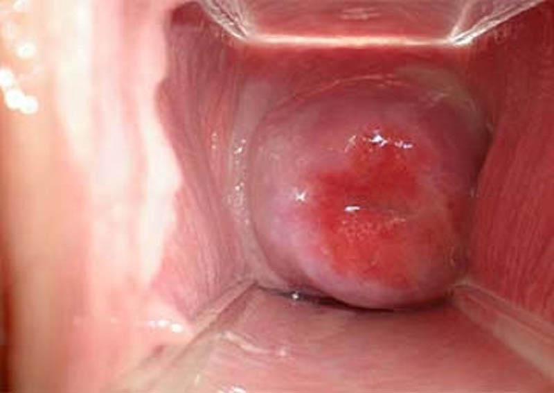 Viêm Âm Đạo Do Thiếu Nội Tiết