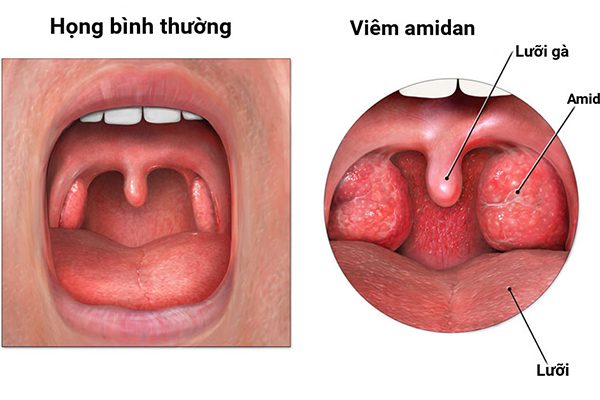 Viêm amiđan ở trẻ em