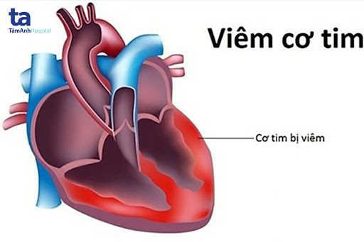 Viêm cơ tim