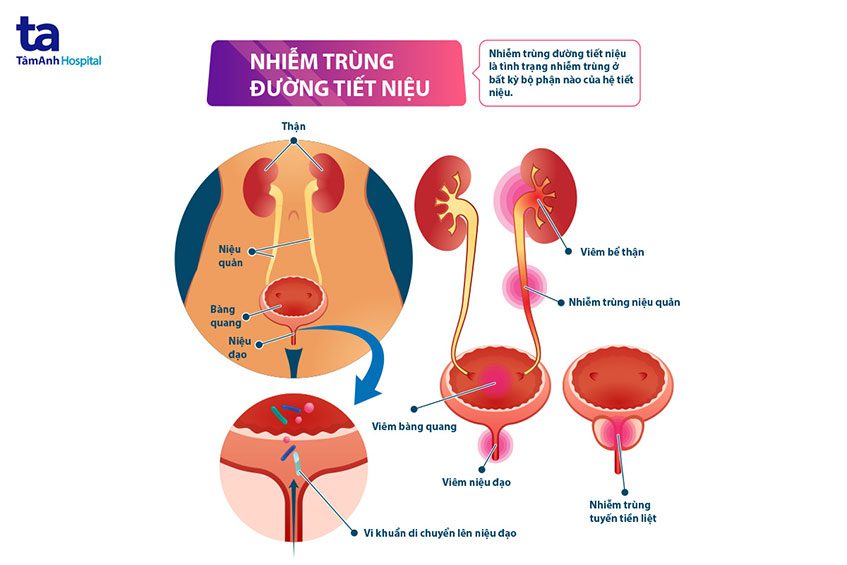Viêm đường tiết niệu không đặc hiệu