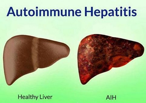 Viêm gan tự miễn (Autoimmune hepatitis)