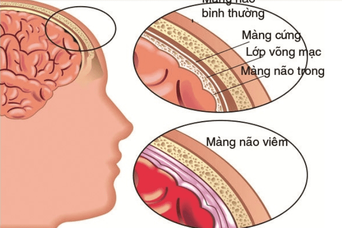 Viêm màng não mủ ở trẻ em