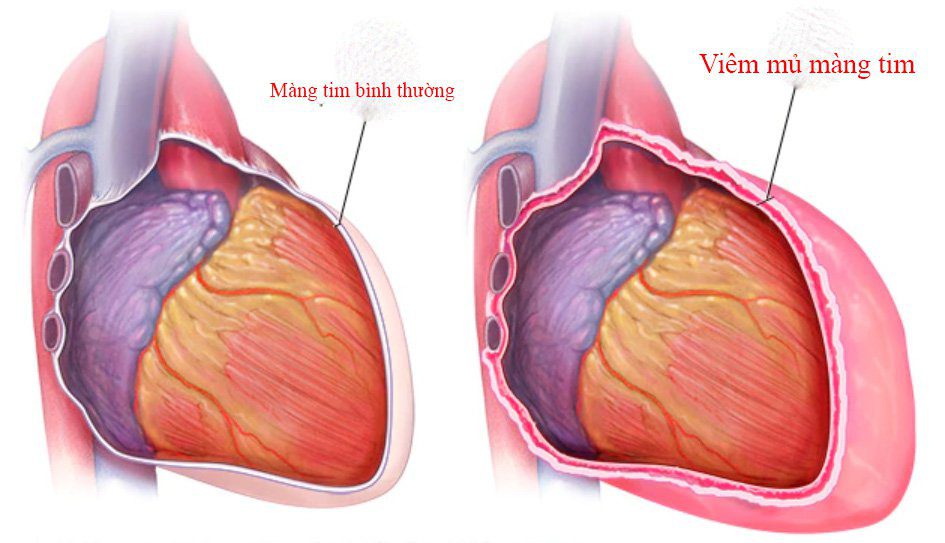 Viêm Mủ Màng Ngoài Tim