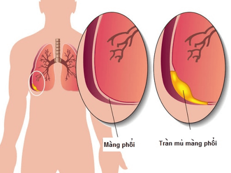 Viêm Mủ Màng Phổi