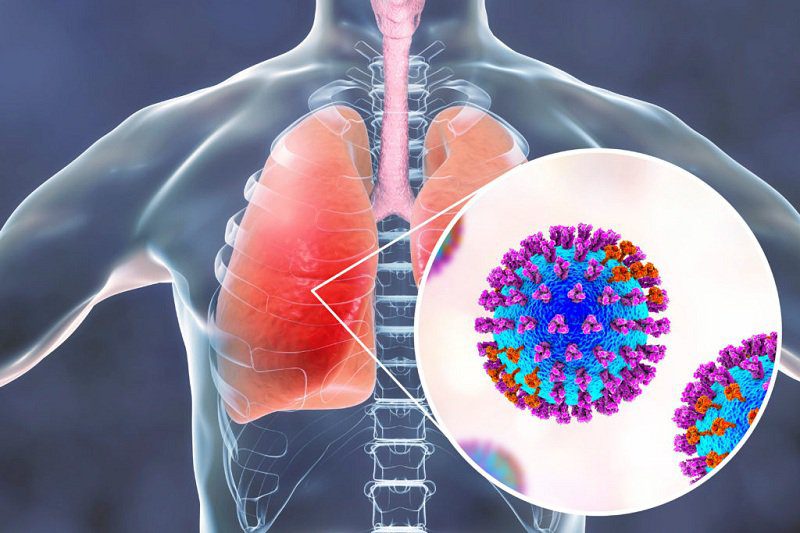 Viêm Phổi Do Virus