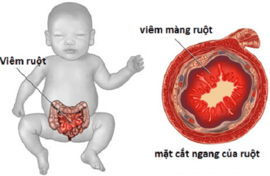 Viêm Ruột Hoại Tử Sơ Sinh