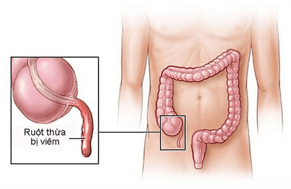 Viêm ruột thừa cấp