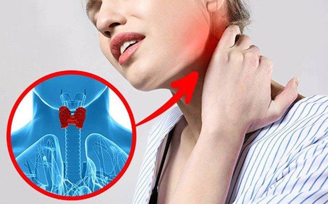 Viêm tuyến giáp cấp tính do vi khuẩn