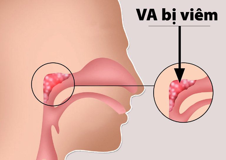 Viêm V.A ở trẻ em