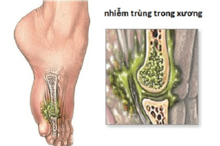 Viêm xương tủy nhiễm khuẩn