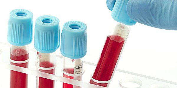 Xét nghiệm Alpha-fetoprotein (AFP)