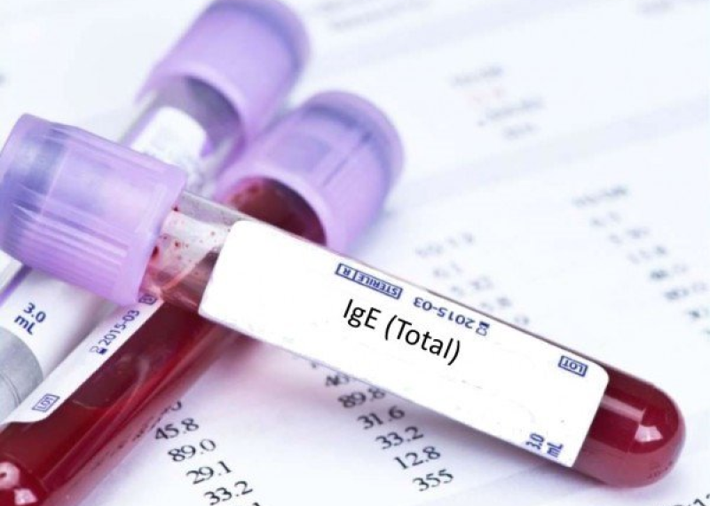 Xét nghiệm Globulin miễn dịch E (IgE)