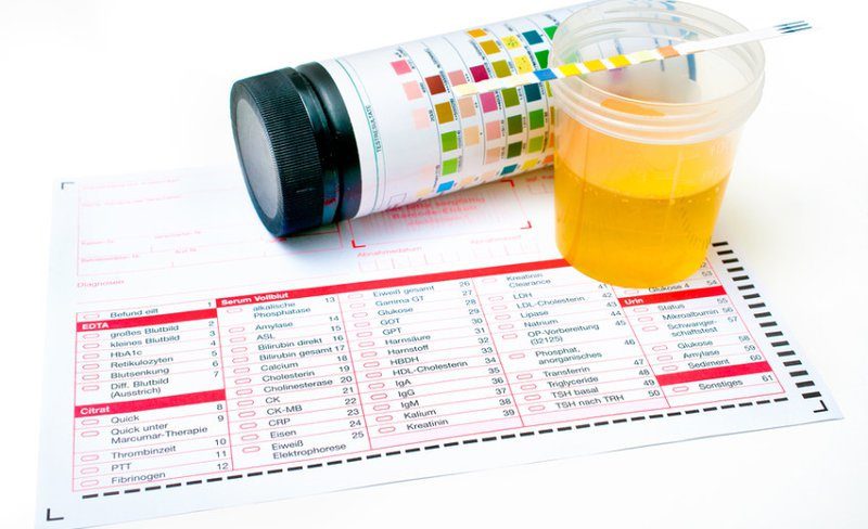 Xét nghiệm Glucose niệu
