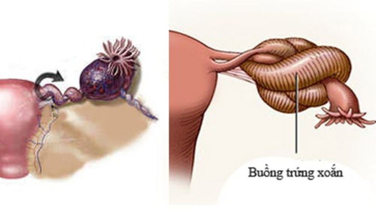 Xoắn buồng trứng ở trẻ em