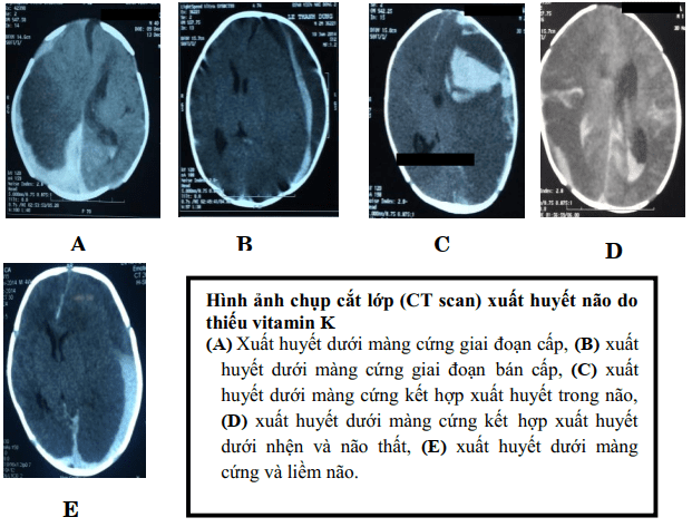 Xuất huyết do thiếu vitamin K