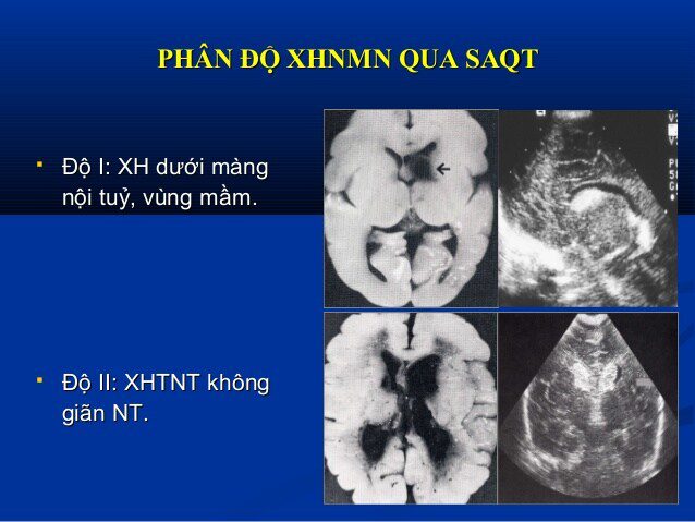 Xuất huyết não vùng mầm