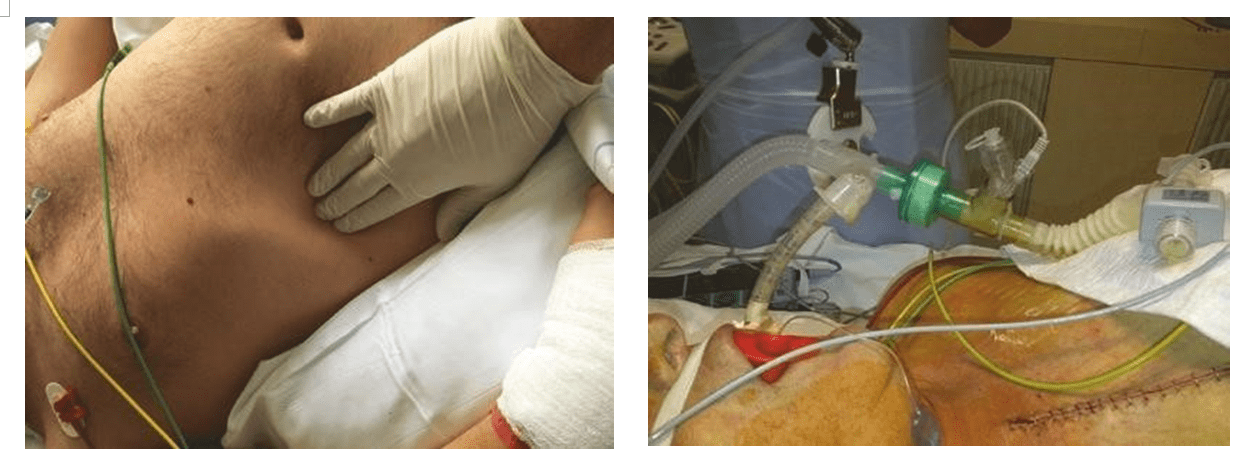 Triệu chứng học trong ICU: Đường thở và phổi