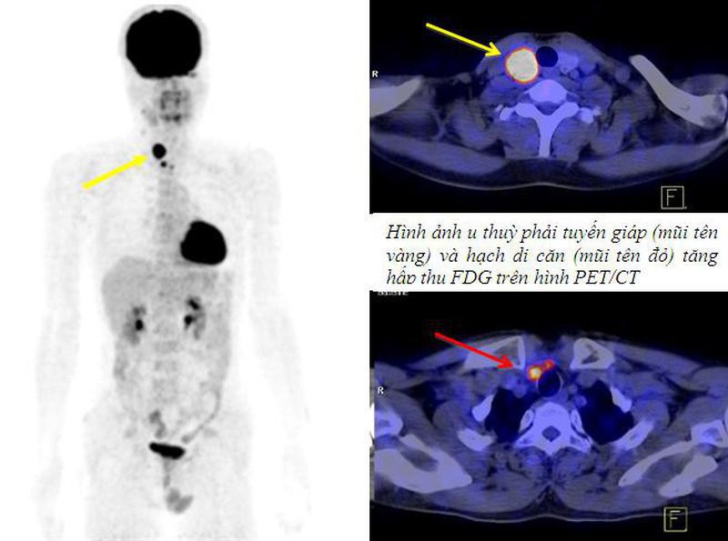 Adenoma tuyến giáp độc – Chẩn đoán và quản lý