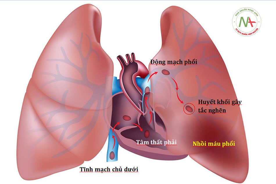 Điều trị, tiên lượng và theo dõi bệnh nhân thuyên tắc phổi cấp