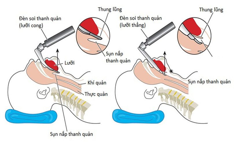 Kỹ thuật đặt nội khí quản cấp cứu