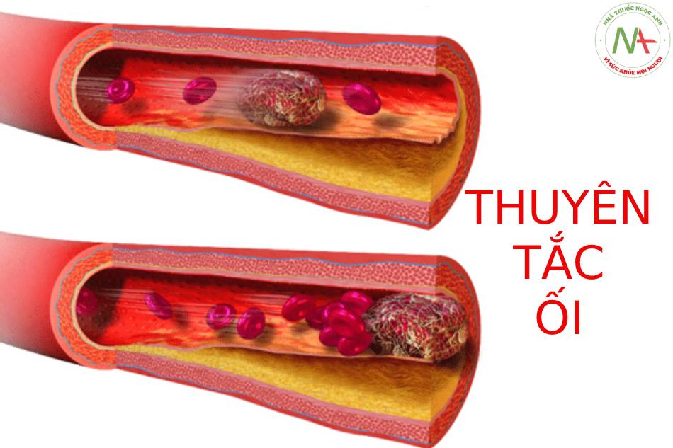 Thuyên tắc ối: Bệnh sinh, Chẩn đoán và Hồi sức