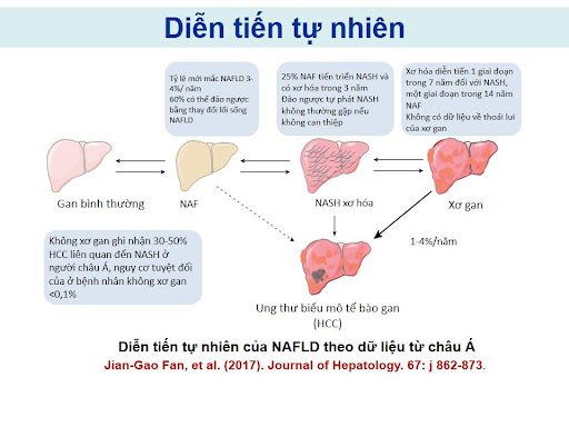 Bệnh gan nhiễm mỡ không do rượu (NAFLD)