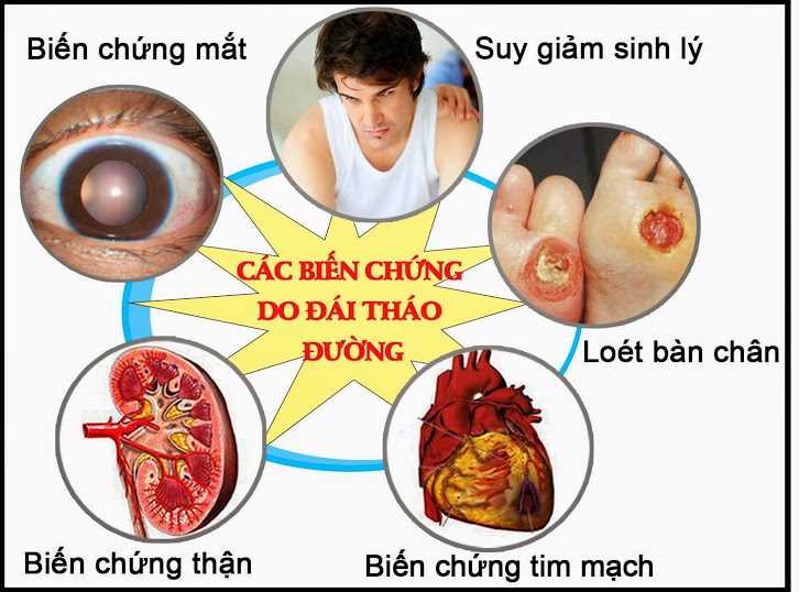 Cập nhật các nhân tố di truyền của bệnh thần kinh tiểu đường