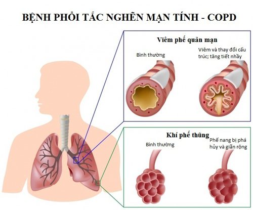Loạn nhịp tim trong bệnh phổi tắc nghẽn mãn tính