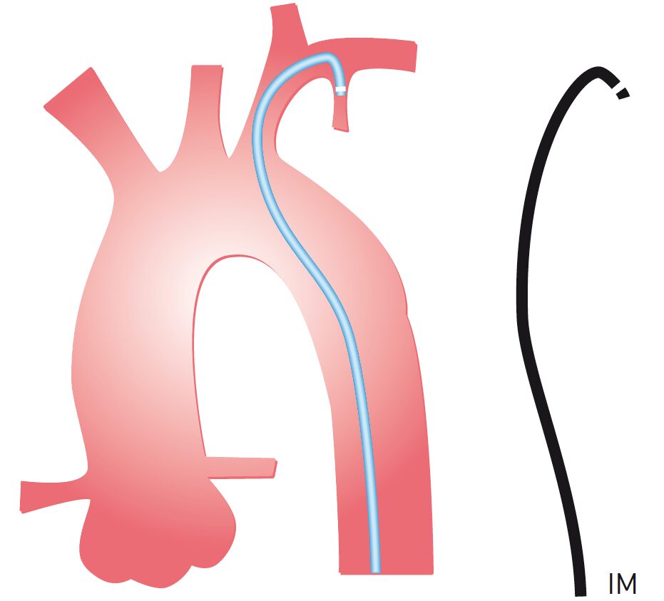 Dụng cụ ống thông (catheter) trong chụp và can thiệp mạch vành