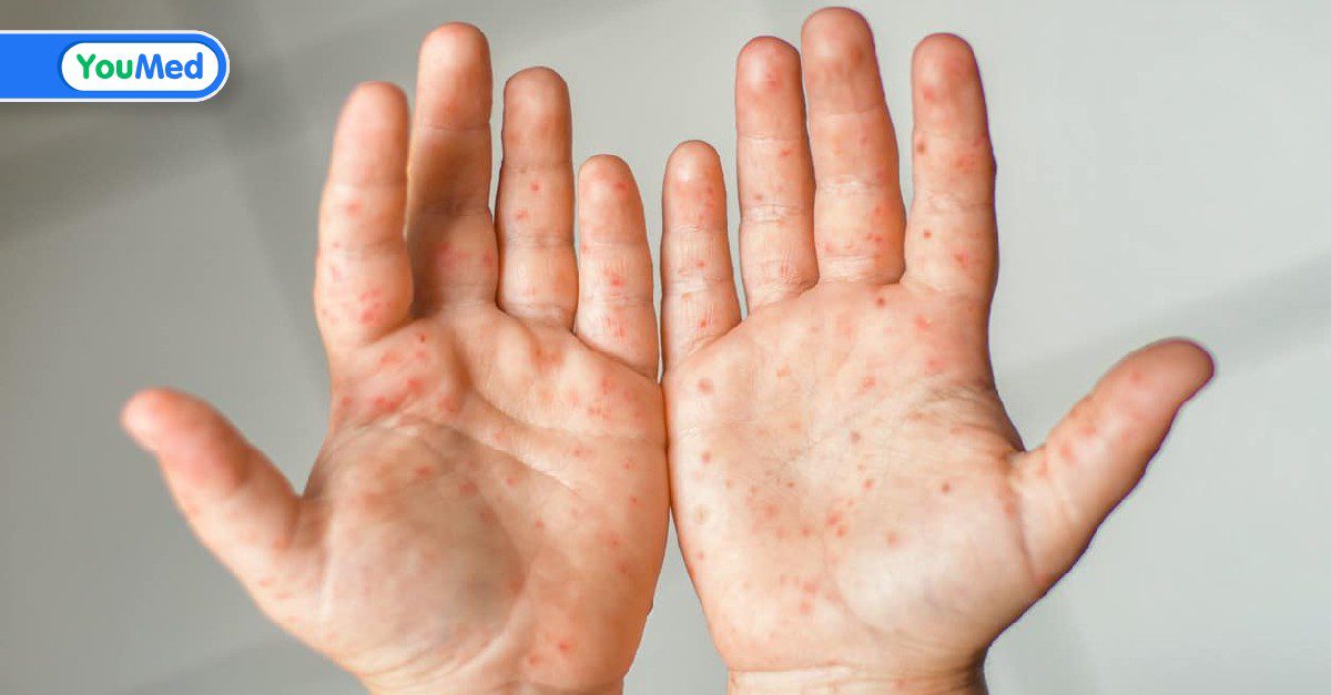 Bài giảng nhi khoa: Bệnh tay chân miệng ở trẻ em
