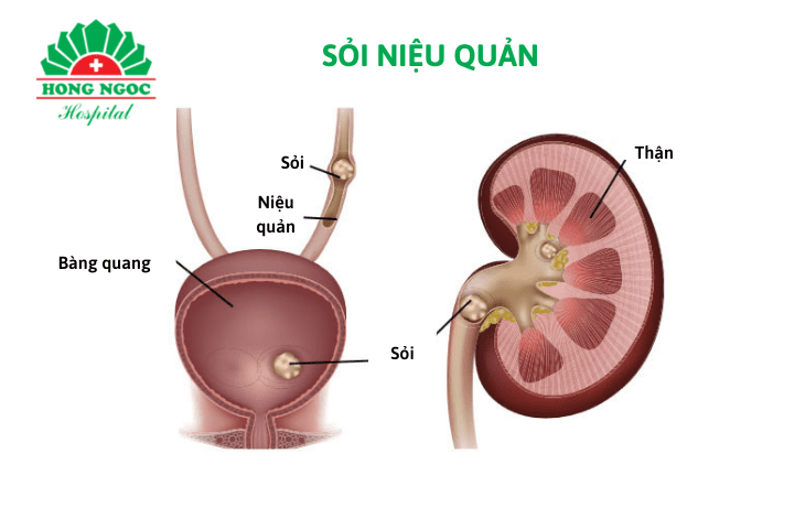 Các phương pháp điều trị Sỏi niệu quản