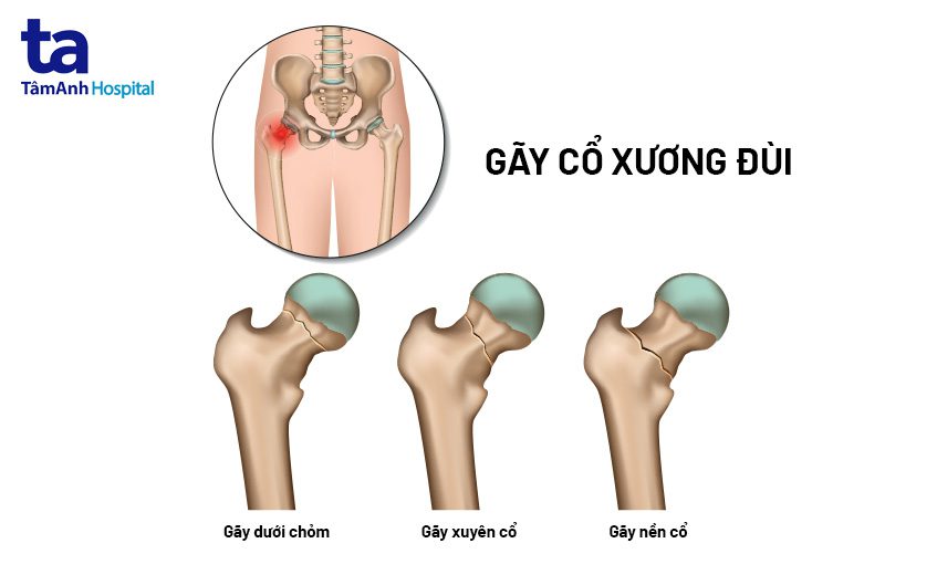 Gãy cổ xương đùi