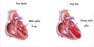 Suy Tim: Lượng Giá Và Điều Trị Lâu Dài