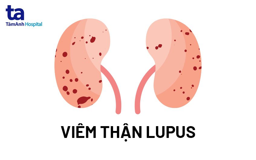 Viêm Thận Lupus