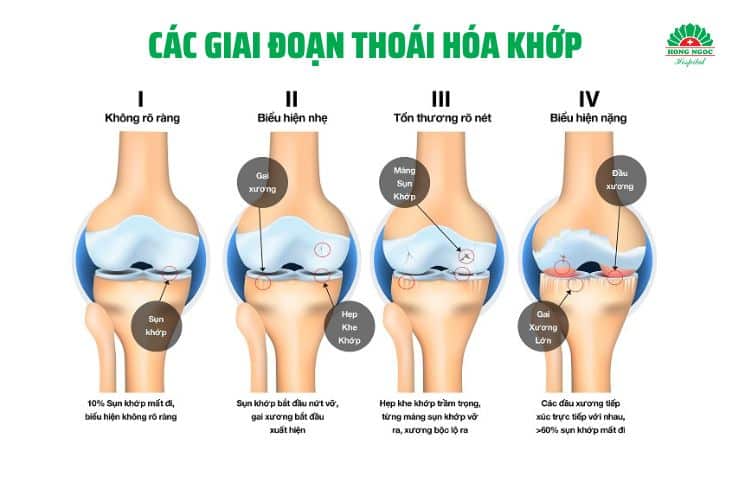 Chẩn đoán và điều trị Thoái hóa khớp gối