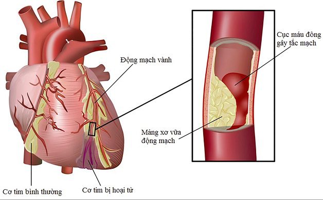 Hội chứng mạch vành cấp tính: Định nghĩa và phân loại