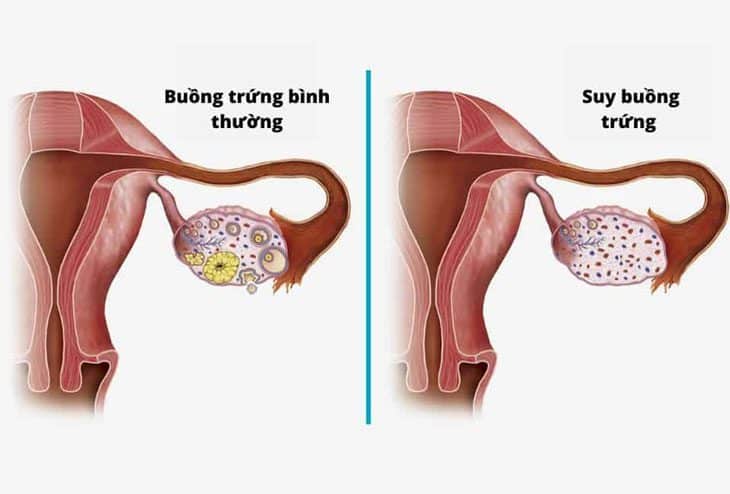 Suy buồng trứng sớm
