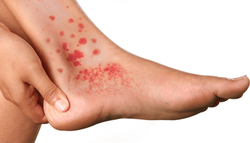 Điều trị hội chứng Behcet